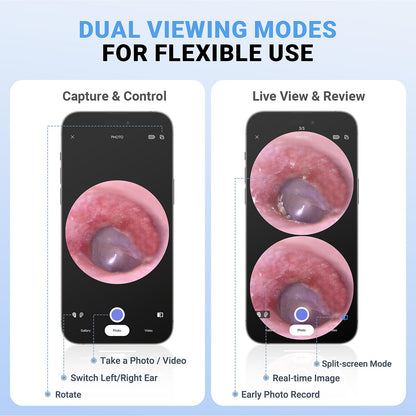 ScopeAround Otoscope, 720PHD Ear Scope Set, Digital Otoscope w/1.85in IPS Screen, Ear Wax Removal Tool Camera, Video Otoscope Ear Camera with 6 LED Lights, Compatible with Android/iPhone