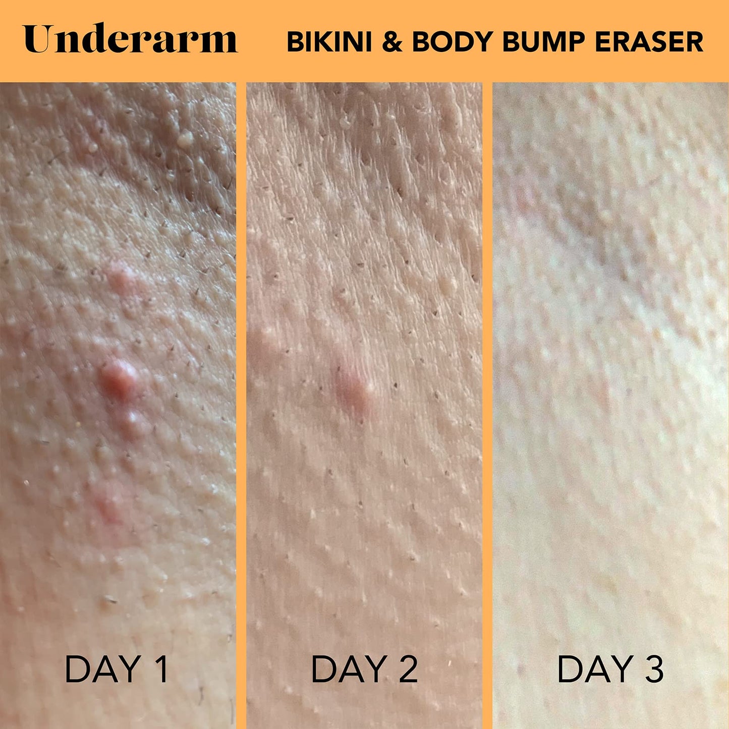SweetSpot Labs Bikini & Body Bump Eraser, Razor Bump and Dark Spot Treatment with Niacinamide, 0.5 oz